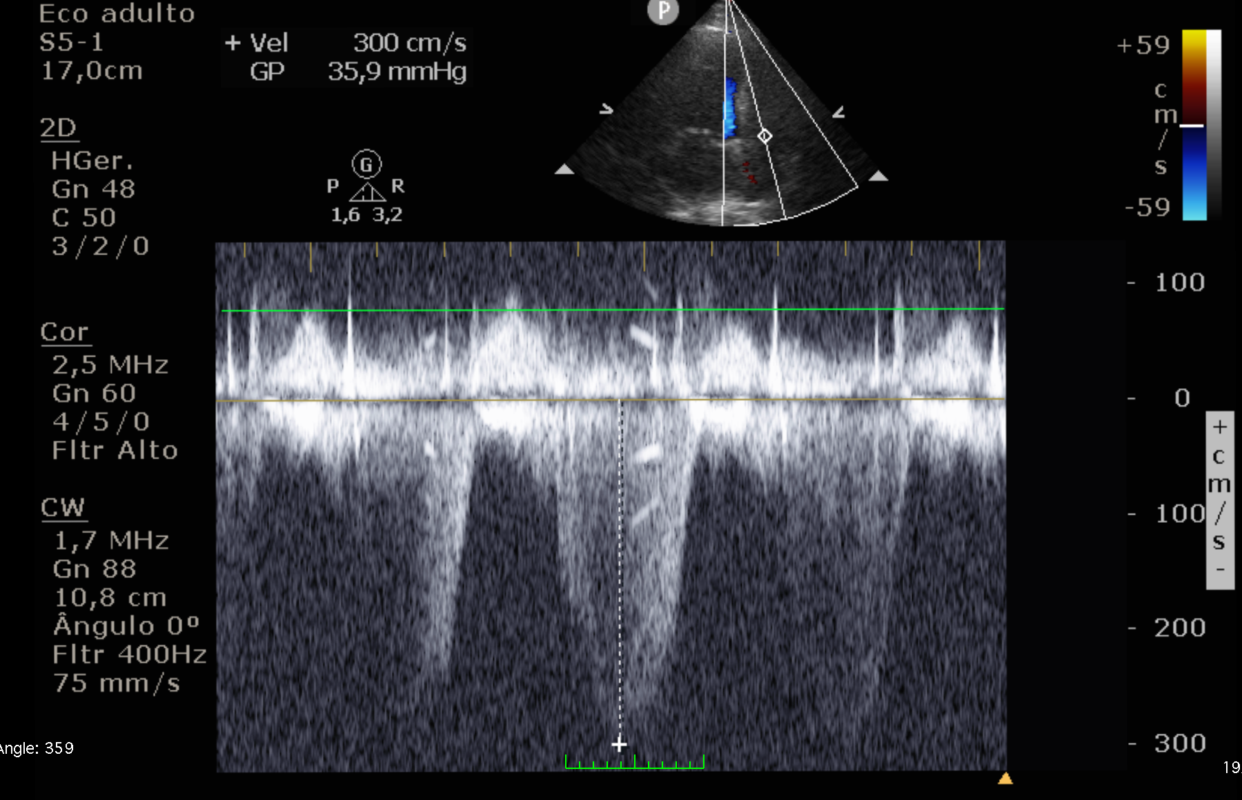 Medição da PASP - Doppler contínuo da regurgitação tricúspide