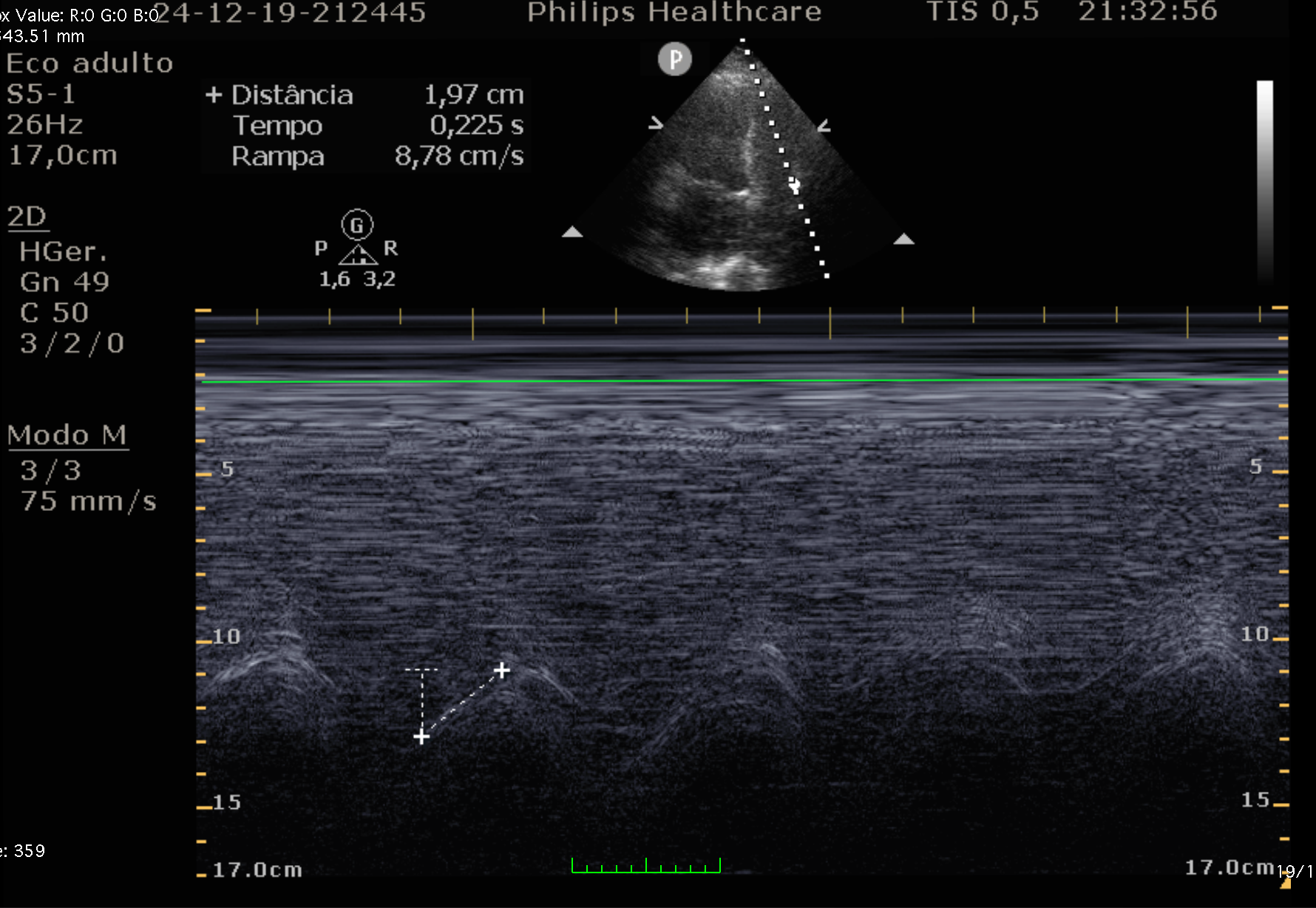Medição do TAPSE - Modo M do anel tricúspide