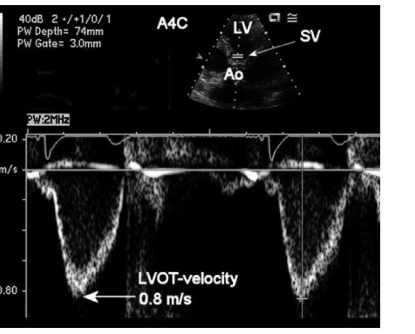 Doppler pulsado da VSVE em janela apical 5 câmaras