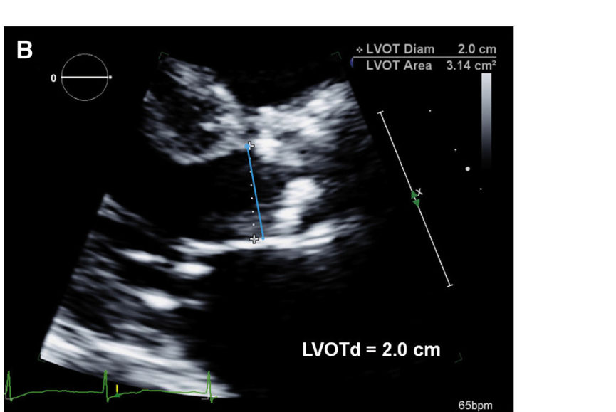 Perfil de fluxo na VSVE e posicionamento correto da amostra do Doppler
